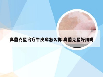 真菌克星治疗牛皮癣怎么样 真菌克星好用吗