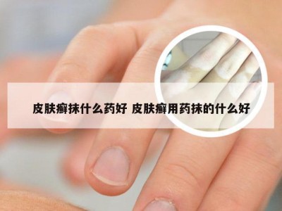 皮肤癣抹什么药好 皮肤癣用药抹的什么好