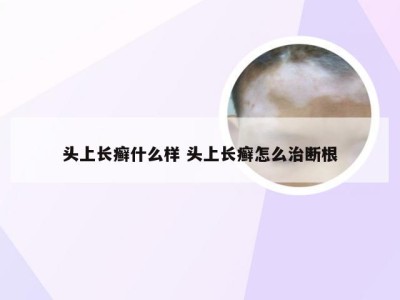 头上长癣什么样 头上长癣怎么治断根