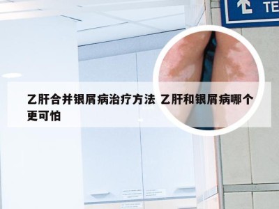 乙肝合并银屑病治疗方法 乙肝和银屑病哪个更可怕