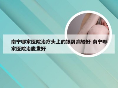 南宁哪家医院治疗头上的银屑病较好 南宁哪家医院治脱发好