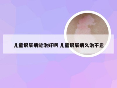 儿童银屑病能治好啊 儿童银屑病久治不愈