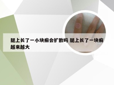 腿上长了一小块癣会扩散吗 腿上长了一块癣越来越大