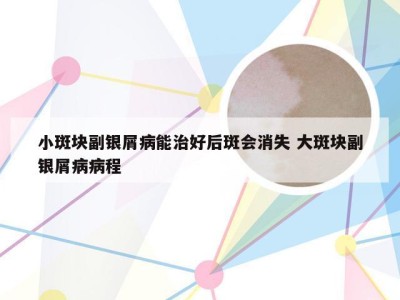 小斑块副银屑病能治好后斑会消失 大斑块副银屑病病程