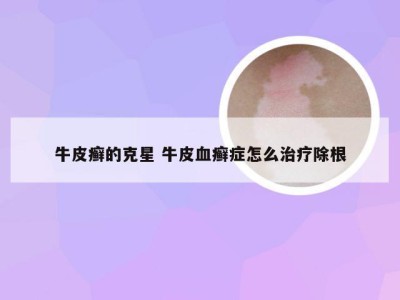 牛皮癣的克星 牛皮血癣症怎么治疗除根