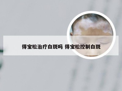 得宝松治疗白斑吗 得宝松控制白斑