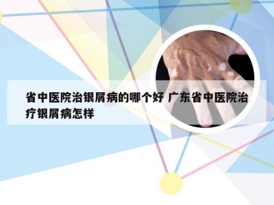 省中医院治银屑病的哪个好 广东省中医院治疗银屑病怎样