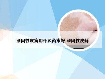 顽固性皮癣用什么药水好 顽固性皮藓