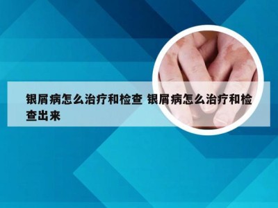 银屑病怎么治疗和检查 银屑病怎么治疗和检查出来