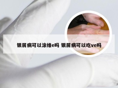 银屑病可以涂维e吗 银屑病可以吃ve吗