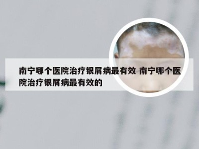 南宁哪个医院治疗银屑病最有效 南宁哪个医院治疗银屑病最有效的