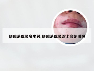 蜕癣消痒灵多少钱 蜕癣消痒灵涂上会刺激吗