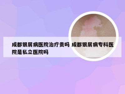 成都银屑病医院治疗贵吗 成都银屑病专科医院是私立医院吗