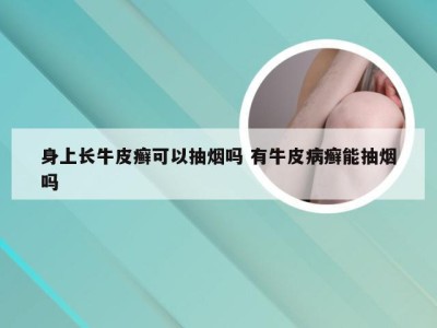 身上长牛皮癣可以抽烟吗 有牛皮病癣能抽烟吗