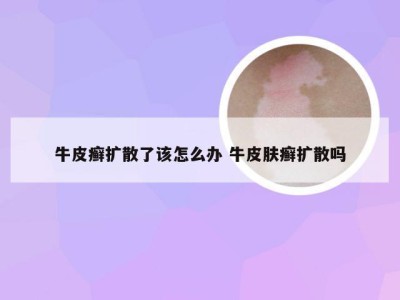 牛皮癣扩散了该怎么办 牛皮肤癣扩散吗