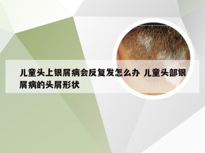 儿童头上银屑病会反复发怎么办 儿童头部银屑病的头屑形状