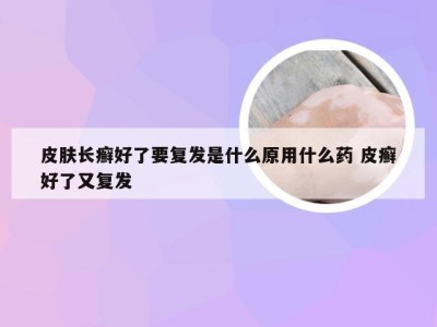 皮肤长癣好了要复发是什么原用什么药 皮癣好了又复发