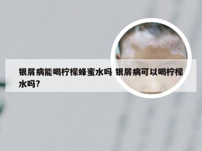 银屑病能喝柠檬蜂蜜水吗 银屑病可以喝柠檬水吗?