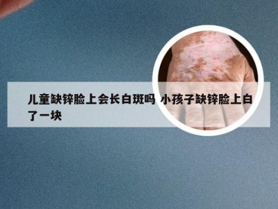 儿童缺锌脸上会长白斑吗 小孩子缺锌脸上白了一块