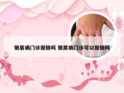 银屑病门诊报销吗 银屑病门诊可以报销吗