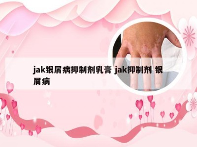 jak银屑病抑制剂乳膏 jak抑制剂 银屑病