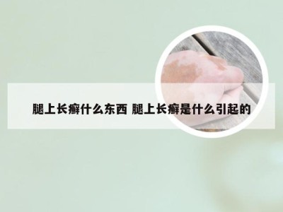 腿上长癣什么东西 腿上长癣是什么引起的