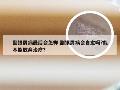 副银屑病最后会怎样 副银屑病会自愈吗?能不能放弃治疗?