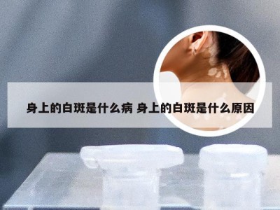 身上的白斑是什么病 身上的白斑是什么原因