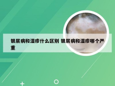 银屑病和湿疹什么区别 银屑病和湿疹哪个严重