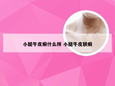 小腿牛皮癣什么样 小腿牛皮肤癣