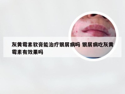 灰黄霉素软膏能治疗银屑病吗 银屑病吃灰黄霉素有效果吗