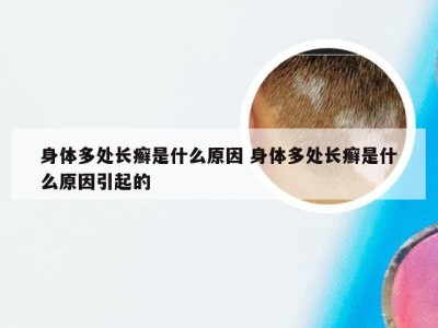 身体多处长癣是什么原因 身体多处长癣是什么原因引起的