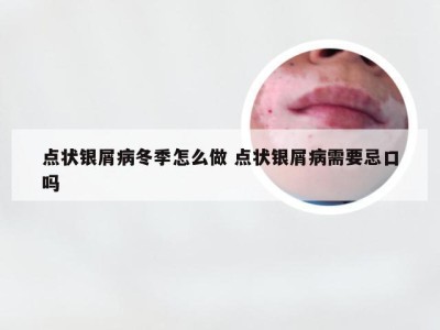 点状银屑病冬季怎么做 点状银屑病需要忌口吗