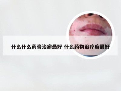 什么什么药膏治癣最好 什么药物治疗癣最好