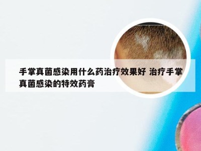 手掌真菌感染用什么药治疗效果好 治疗手掌真菌感染的特效药膏