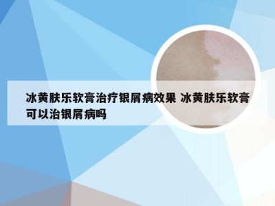 冰黄肤乐软膏治疗银屑病效果 冰黄肤乐软膏可以治银屑病吗