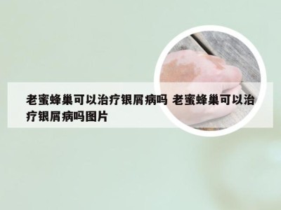 老蜜蜂巢可以治疗银屑病吗 老蜜蜂巢可以治疗银屑病吗图片