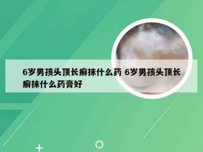 6岁男孩头顶长癣抹什么药 6岁男孩头顶长癣抹什么药膏好