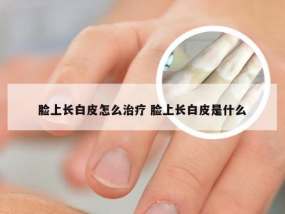 脸上长白皮怎么治疗 脸上长白皮是什么