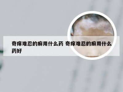 奇痒难忍的癣用什么药 奇痒难忍的癣用什么药好