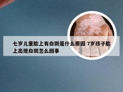 七岁儿童脸上有白斑是什么原因 7岁孩子脸上出现白斑怎么回事