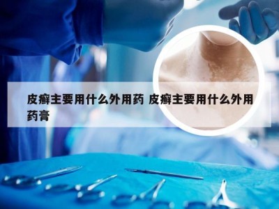 皮癣主要用什么外用药 皮癣主要用什么外用药膏