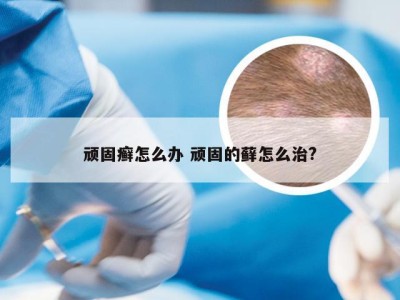 顽固癣怎么办 顽固的藓怎么治?