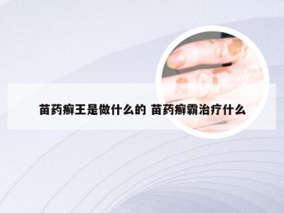 苗药癣王是做什么的 苗药癣霸治疗什么