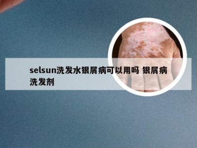 selsun洗发水银屑病可以用吗 银屑病洗发剂