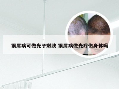 银屑病可做光子嫩肤 银屑病做光疗伤身体吗