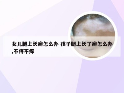 女儿腿上长癣怎么办 孩子腿上长了癣怎么办,不疼不痒