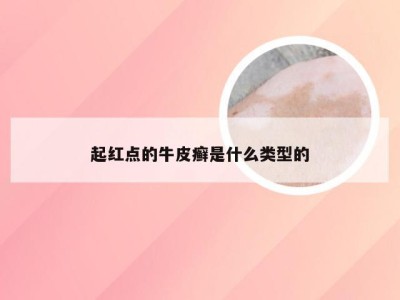 起红点的牛皮癣是什么类型的