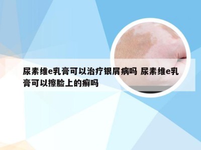 尿素维e乳膏可以治疗银屑病吗 尿素维e乳膏可以擦脸上的癣吗