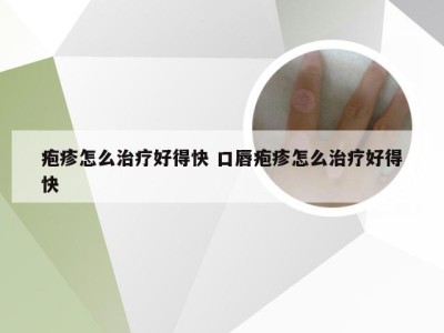 疱疹怎么治疗好得快 口唇疱疹怎么治疗好得快